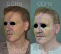 57 year old man treated with SMAS Facelift
