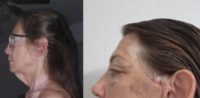 55-64 year old woman treated with Neck Lift, Facelift, Eyelid Surgery, Chemical Peel
