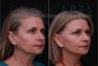 55-64 year old woman treated with Facelift