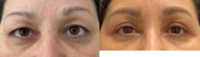 55-64 year old woman treated with Eyelid Surgery