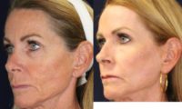 55-64 year old woman treated with Renuvion facial resurfacing