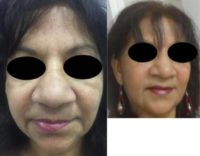 55-64 year old woman treated with Facelift