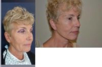 55-64 year old woman treated with Facelift