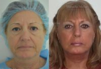 55-64 year old man treated with Facelift