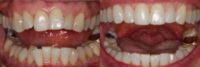 55-64 year old woman treated with Invisalign