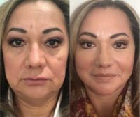 55-64 year old woman treated with Facelift, Fat transfer to face and Lip lift