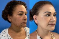 55-64 year old woman treated with Facelift, Facial Fat Transfer
