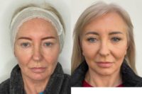 55-64 year old woman treated with Facelift, CO2 Laser, Neck Lift, Eyelid Surgery