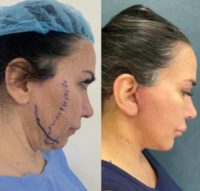 55-64 year old woman treated with Double Eyelid Surgery