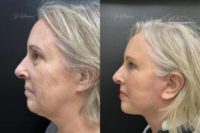 55-64 year old woman treated with Facelift, Eyelid Surgery