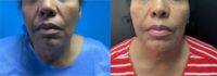 55-64 year old woman treated with Chin Liposuction
