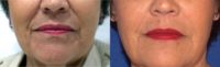 55-64 year old woman treated with Injectable Fillers (Juvederm Vollure)