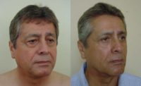 55-64 year old man treated with Facelift