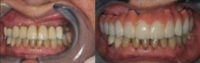 55-64 year old woman treated with Dental Implants