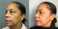 55-64 year old woman treated with Eyelid Surgery