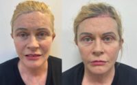 64 year old woman treated with Facelift, Botox, Eyelid Surgery
