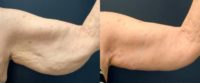 65-74 year old woman treated with Arm Lift