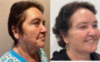 65-74 year old woman treated with Facelift, Neck Lift