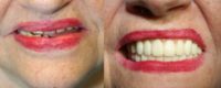65-74 year old woman treated with All-on-4 Dental Implants