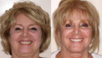 65-74 year old woman Smile Makeover