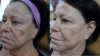 65-74 year old woman treated with Non Surgical Face Lift