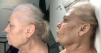 65-74 year old woman treated with Morpheus8: Face, Eyes (M8 Prime), and PRP