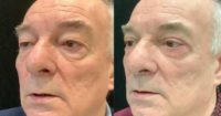 65-74 year old man treated with Eyelid Surgery