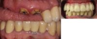 65-74 year old man treated with All-on-4 Dental Implants