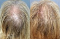 65-74 year old woman treated with Hair Loss Treatment