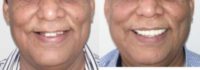 65-74 year old man treated with Dental Implants