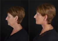 65-74 year old woman treated with Facelift