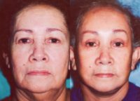 65-74 year old woman treated with Facelift