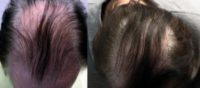 65-74 year old man treated with PRP for Hair Loss