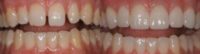 A Forty Three Year Old Female Treated with Porcelain Veneers