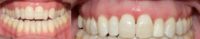 Adult Orthodontic treatment