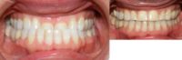 Adult TMJ and orthodontic treatment