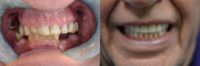 All-on-4 Dental Implants with 65-74 year old man