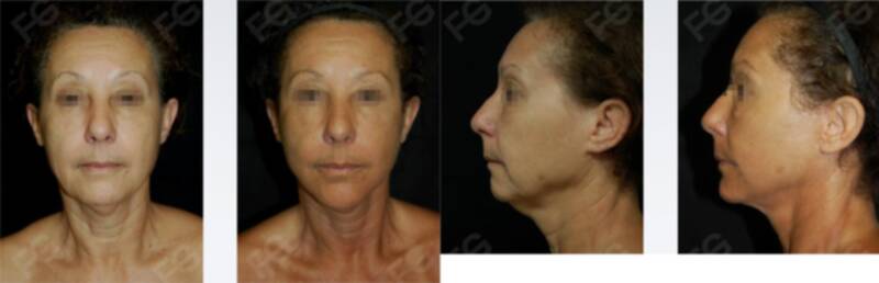 Facelift  with SMAS plicature + Neck liposuction + Chin implant + Facial fat grafting