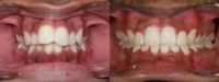 Braces treatment with Arch Expansion