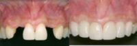 Congenital missing teeth and implants