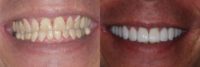 Decayed Teeth Restored With Porcelain Veneers