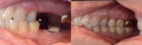 Dental Implant Bridges to Replace Missing Back Teeth