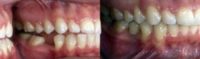 Dental Implants Lower