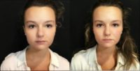25-34 year old woman treated with Restylane Lyft
