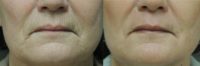 55-64 year old woman treated with Laser Resurfacing
