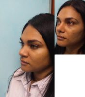 35-44 year old woman treated with Nose Surgery