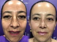 35-44 year old woman treated with Rhinoplasty