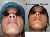 18-24 year old woman treated with Rhinoplasty