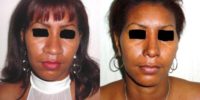 25-34 year old woman treated with African  american Rhinoplasty in Dominican Republic