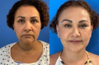 55-64 year old woman treated with Facelift, Facial Fat Transfer